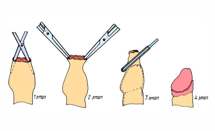 как делают операцию обрезания крайней плоти